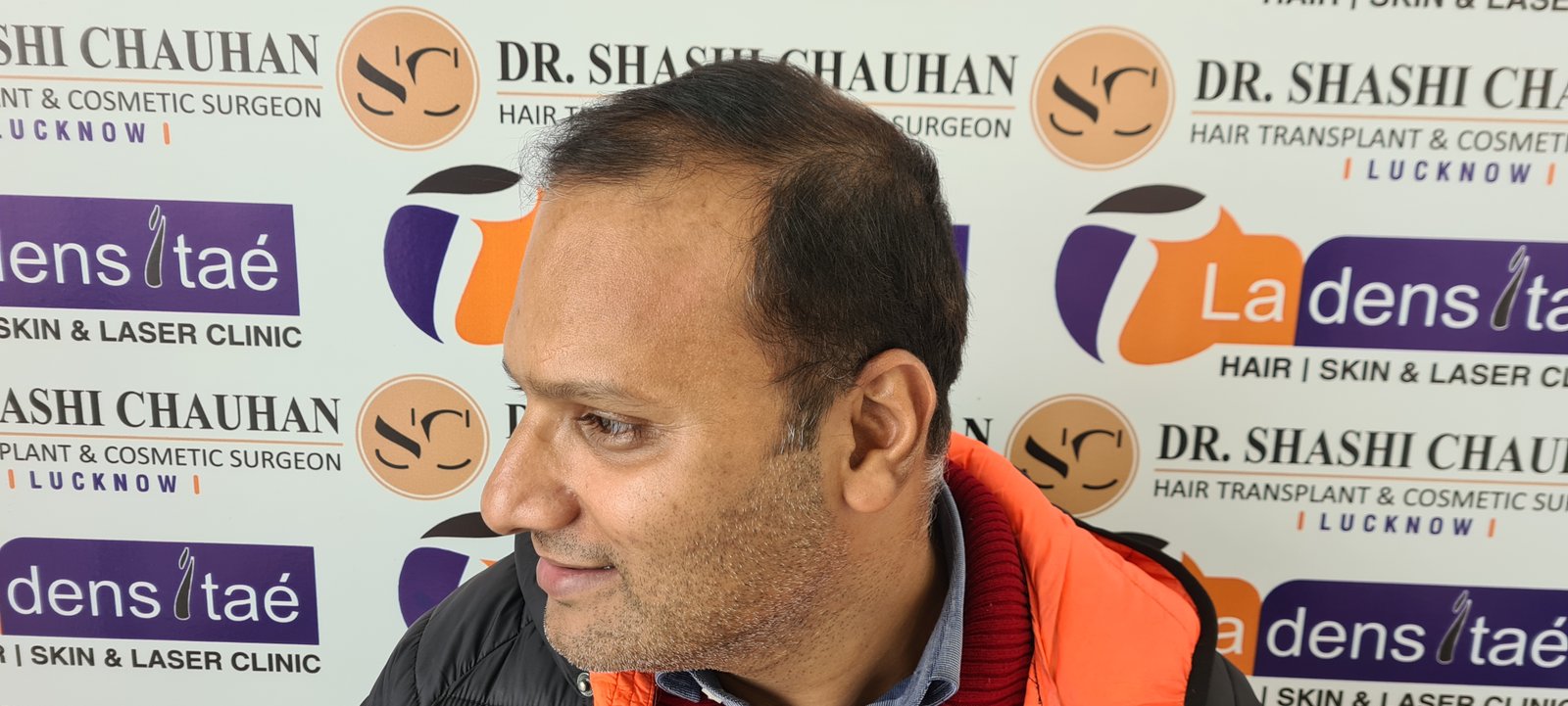Rahul Agrawal Before Hair Transplant